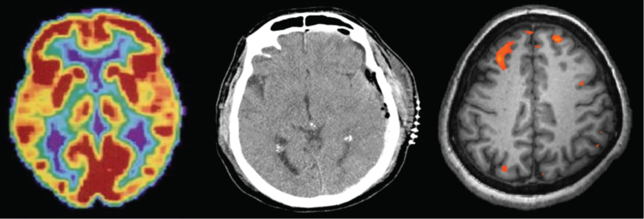 Three brain-imaging scans are shown.