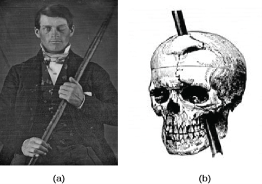 Image (a) is a photograph of Phineas Gage holding a metal rod. Image (b) is an illustration of a skull with a metal rod passing through it from the cheek area to the top of the skull.