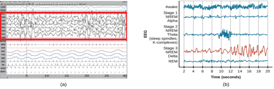 Polysonograph a shows the pattern of delta waves, which are low frequency and high amplitude. Delta waves are found mostly in stage 3 of sleep. Chart b shows brainwaves at various stages of sleep, with stage 3 highlighted.Polysonograph a shows the pattern of delta waves, which are low frequency and high amplitude. Delta waves are found mostly in stage 3 of sleep. Chart b shows brainwaves at various stages of sleep, with stage 3 highlighted.Polysonograph a shows the pattern of delta waves, which are low frequency and high amplitude. Delta waves are found mostly in stage 3 of sleep. Chart b shows brainwaves at various stages of sleep, with stage 3 highlighted.